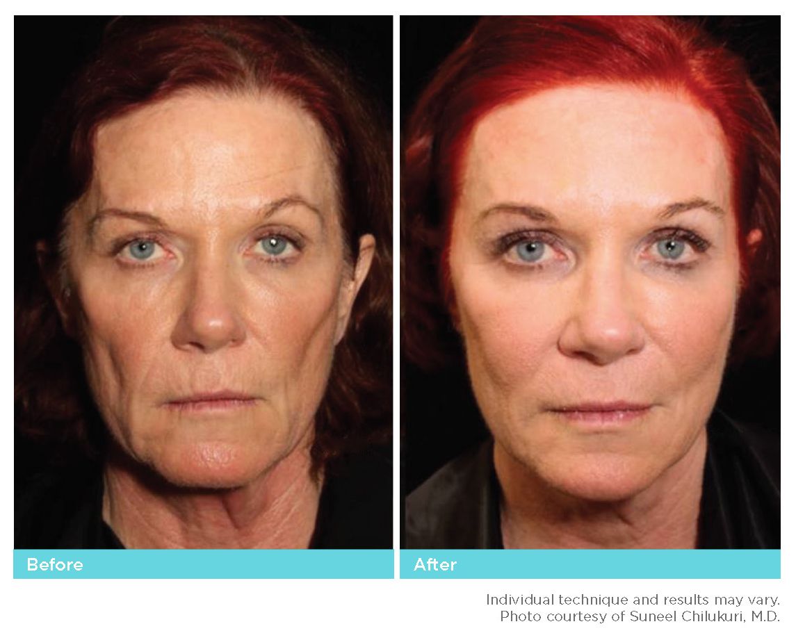 Thread Lift Before & After