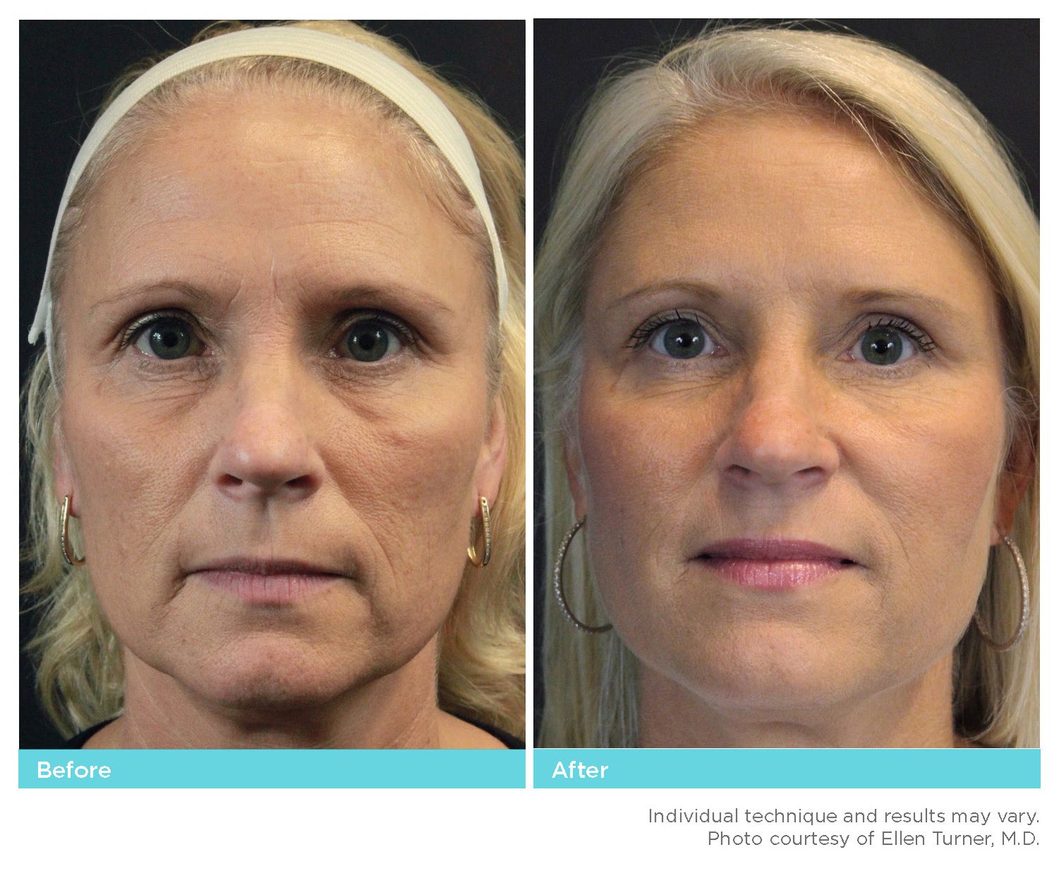 Thread Lift Before & After