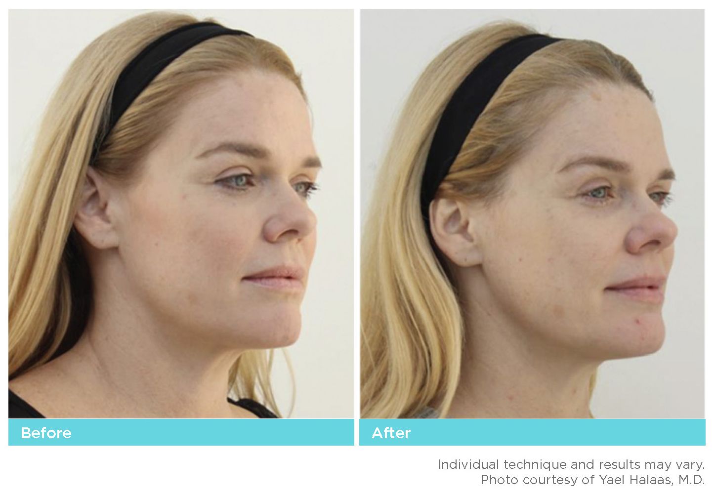 Thread Lift Before & After