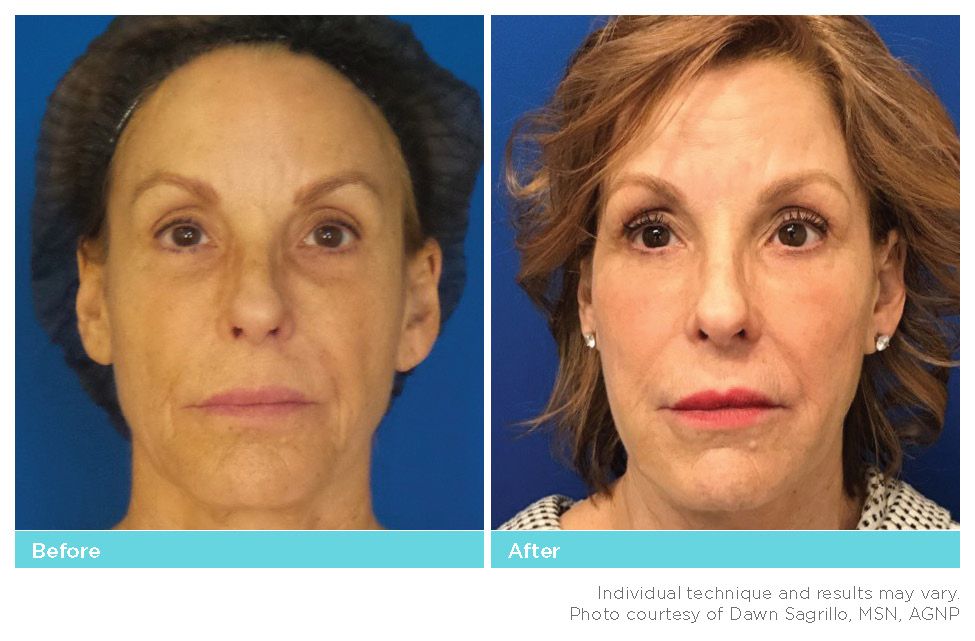 Thread Lift Before & After