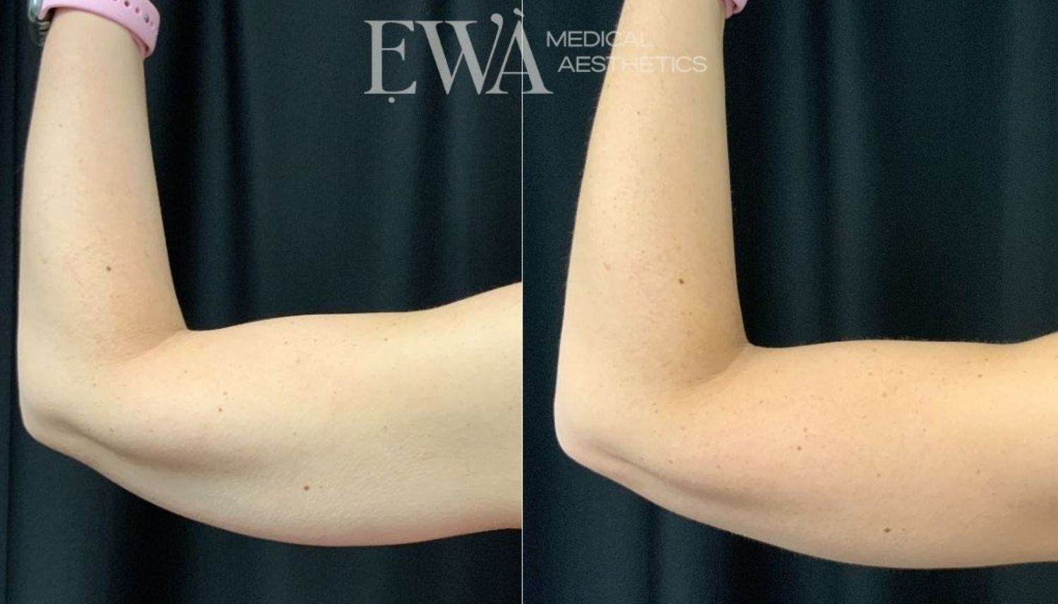 Coolsculpting Before & After