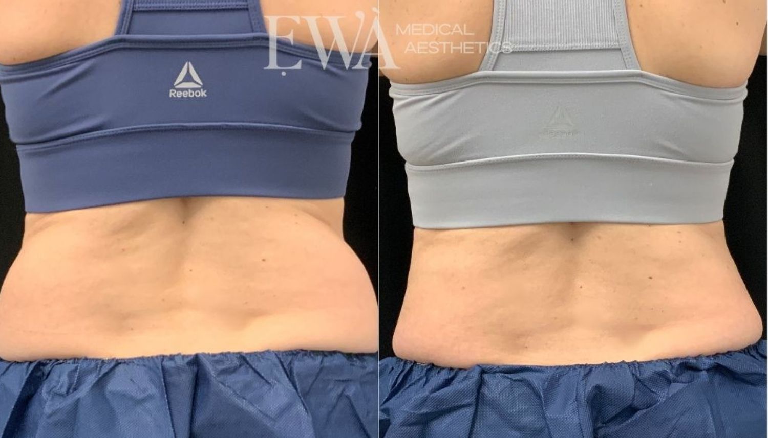 Coolsculpting Before & After