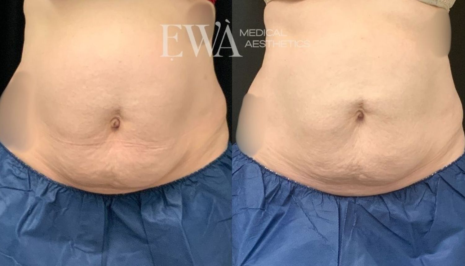 Coolsculpting Before & After