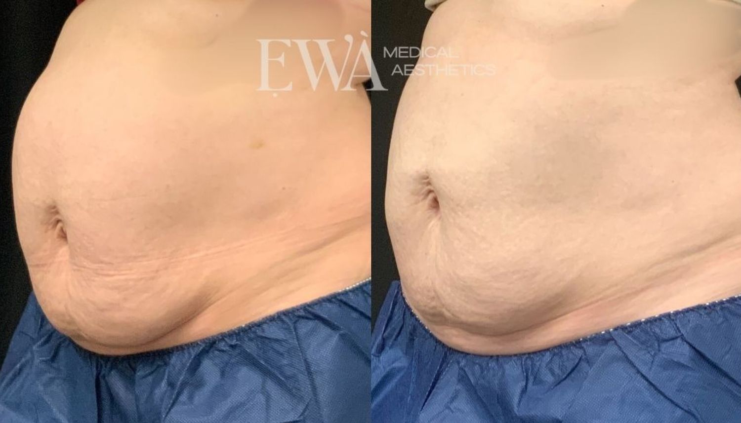 Coolsculpting Before & After