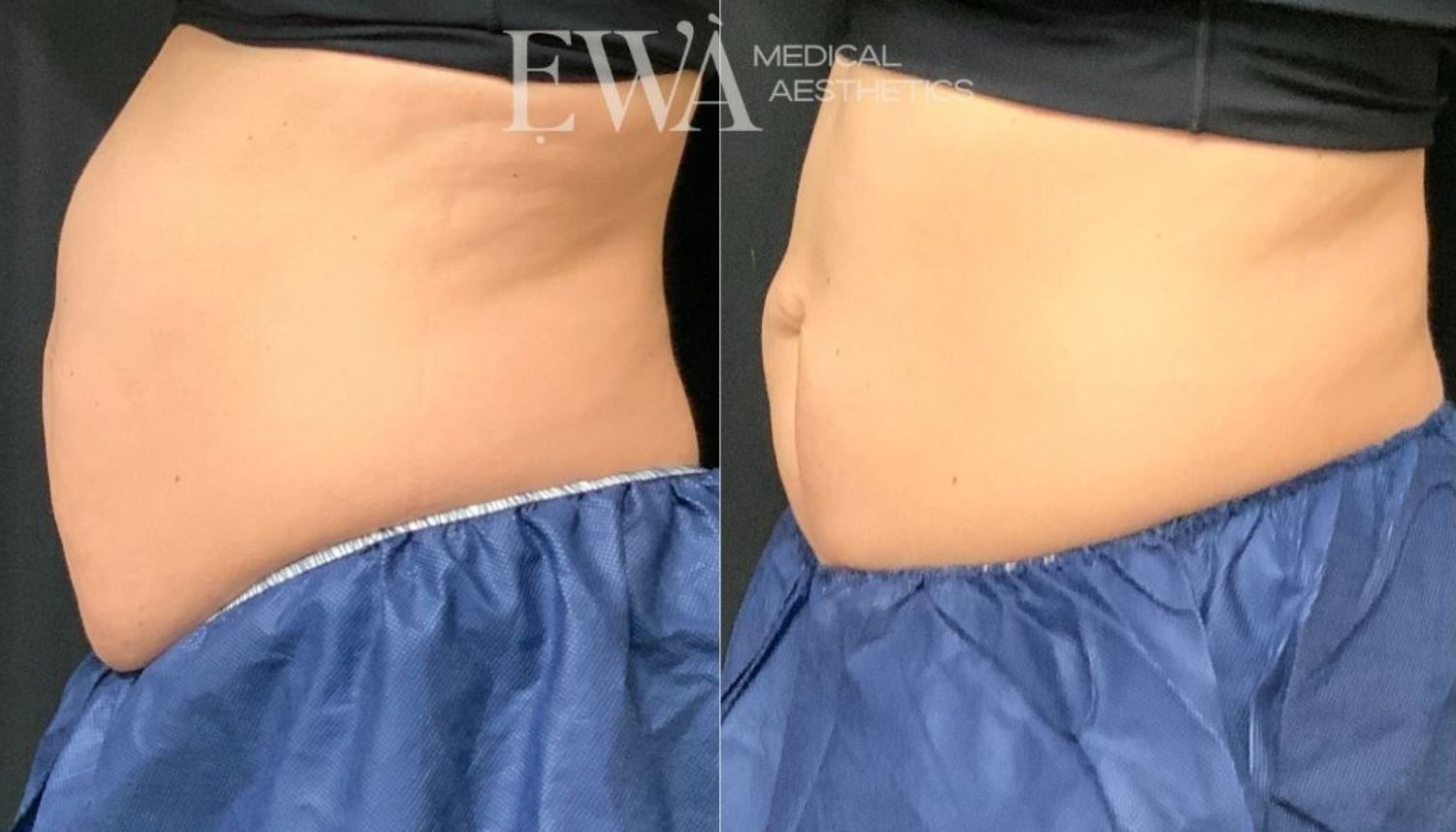 Coolsculpting Before & After