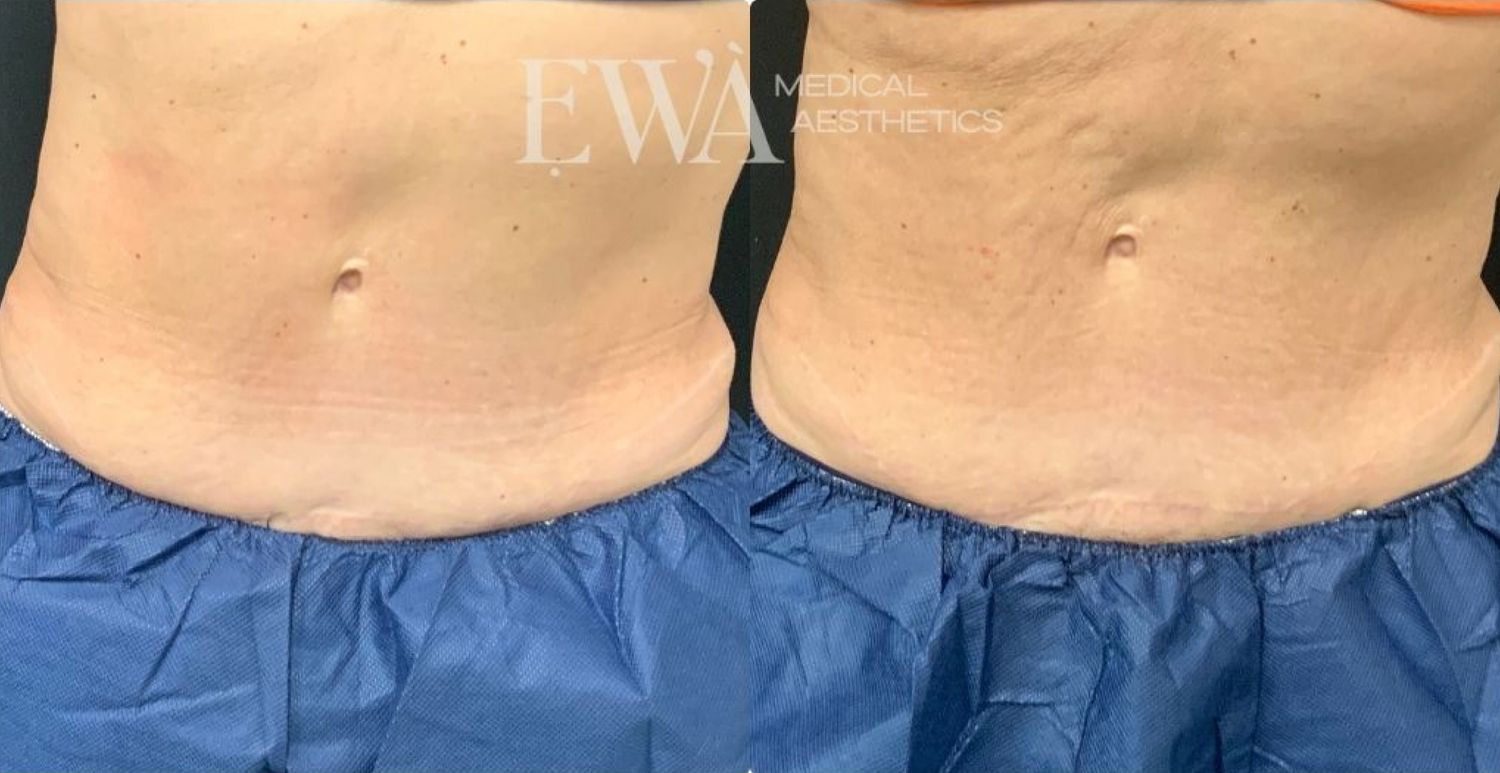 Coolsculpting Before & After