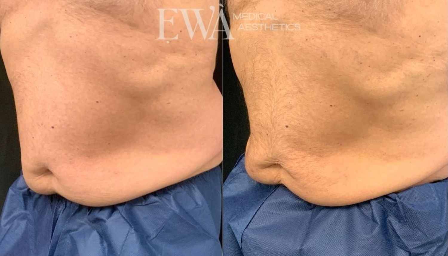 Coolsculpting Before & After