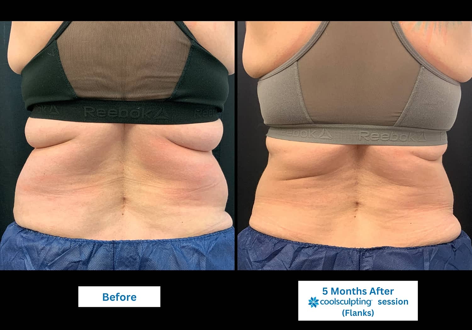 CoolSculpting Before & After