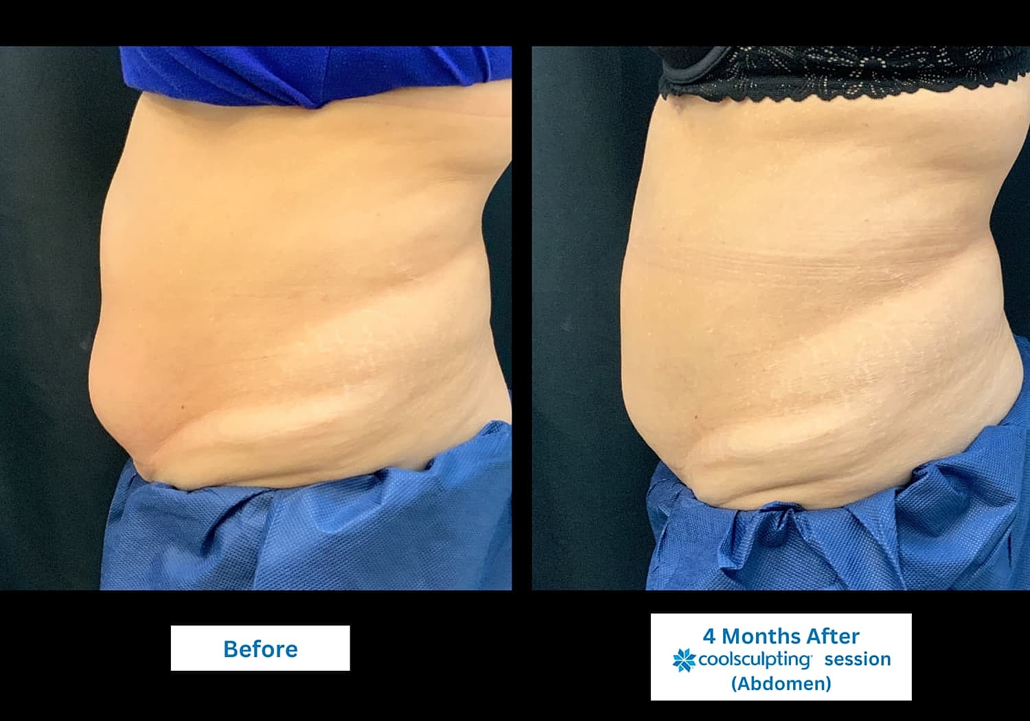 CoolSculpting Before & After