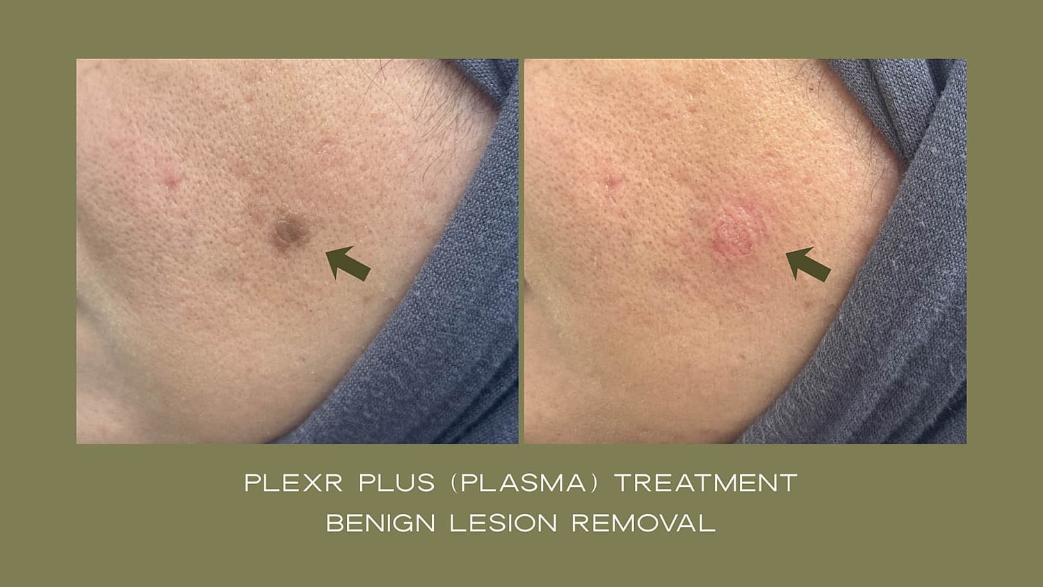 Plexr Before & After