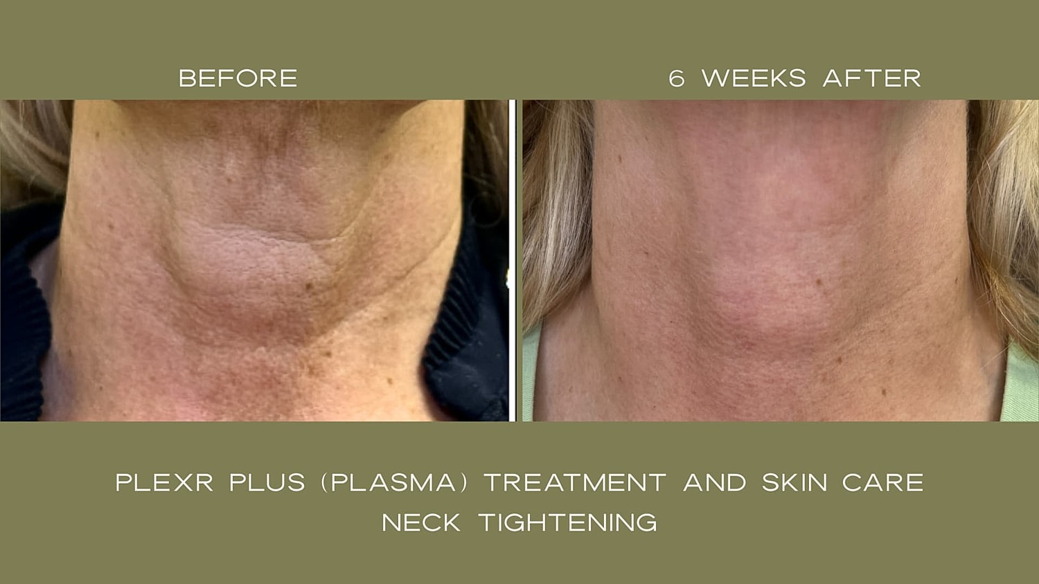 Plexr Before & After