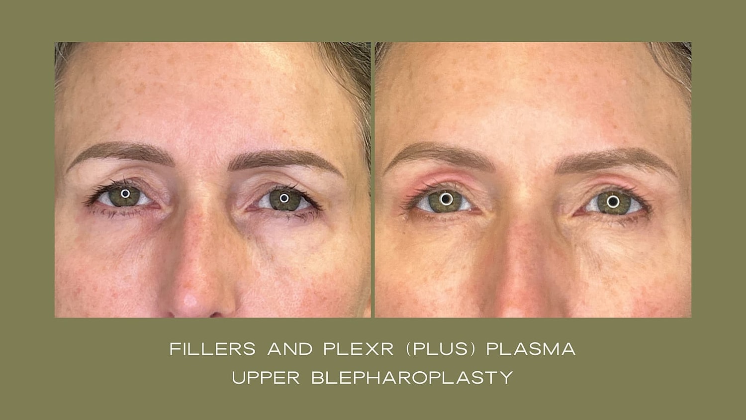 Plexr Before & After