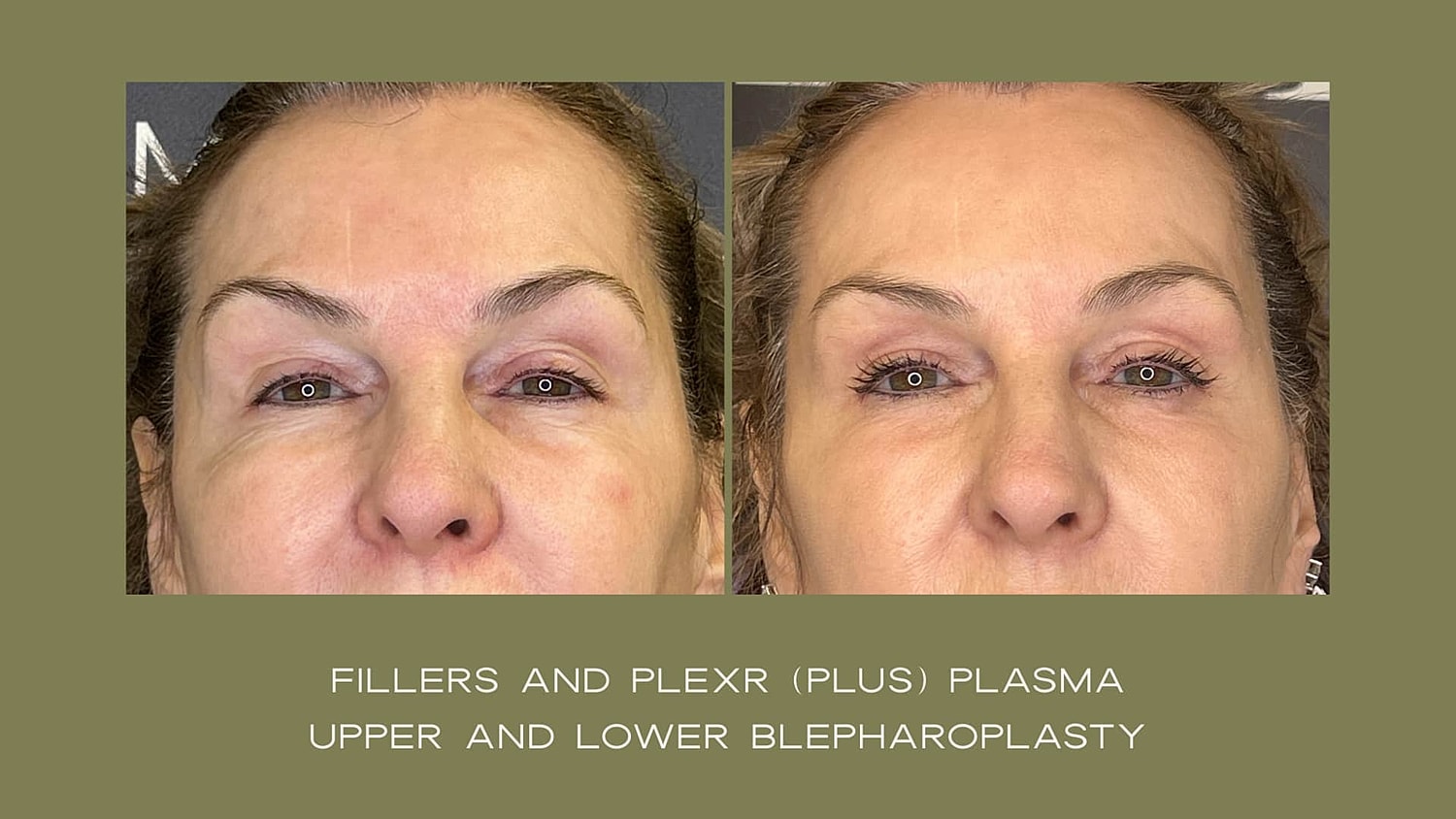 Plexr Before & After