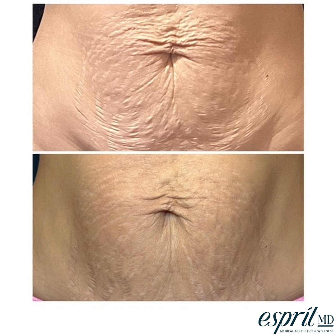 Plexr Before & After