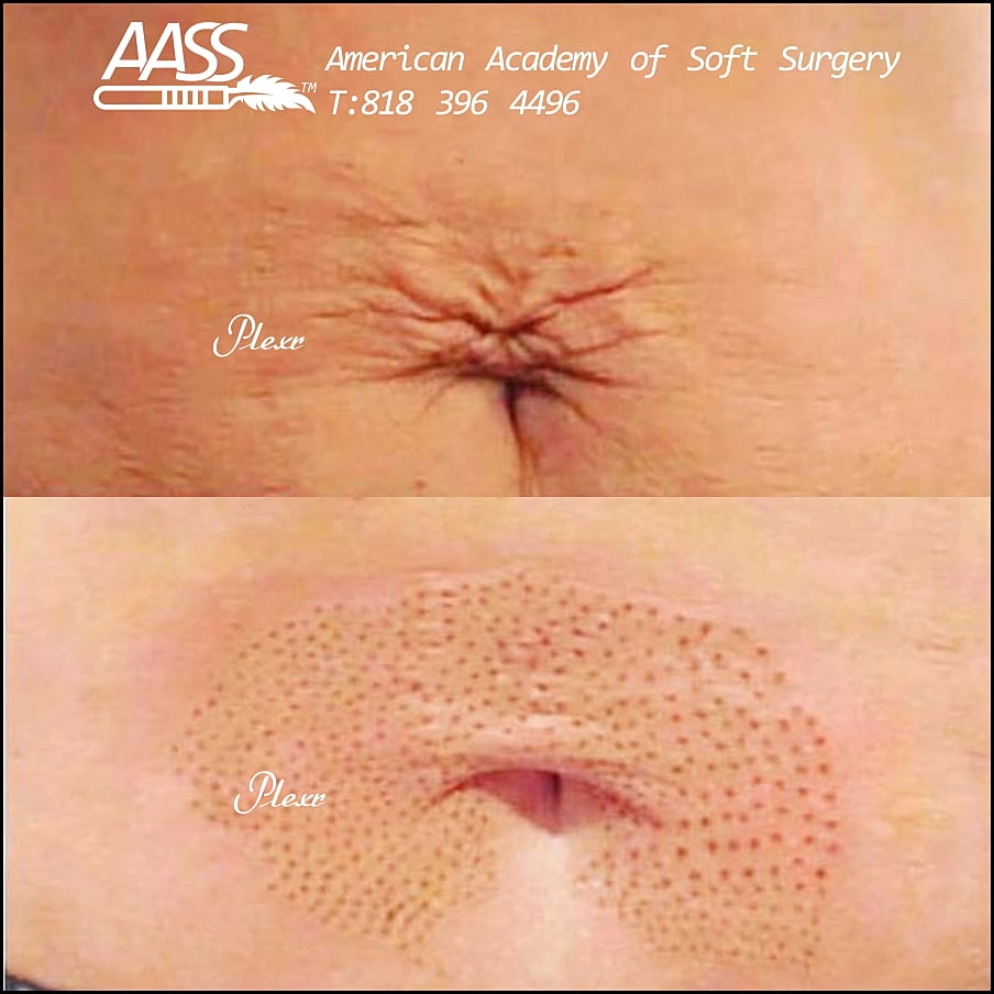 Plexr Before & After