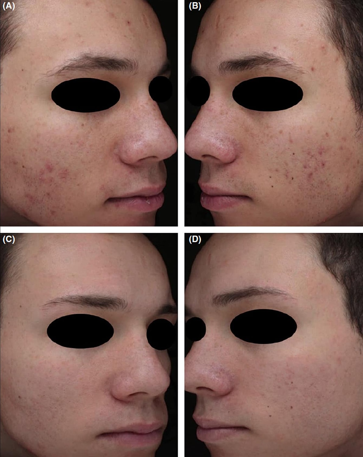 Plexr Before & After