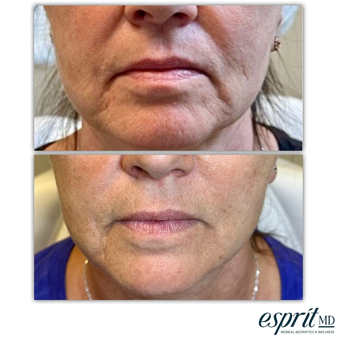 Plexr Before & After