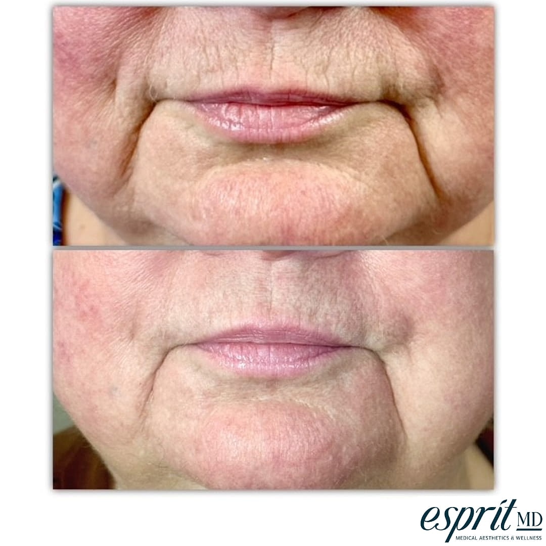 Plexr Before & After