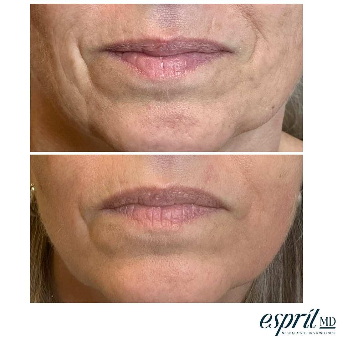 Plexr Before & After