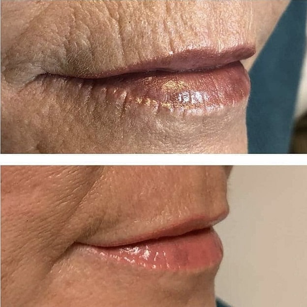 Plexr Before & After