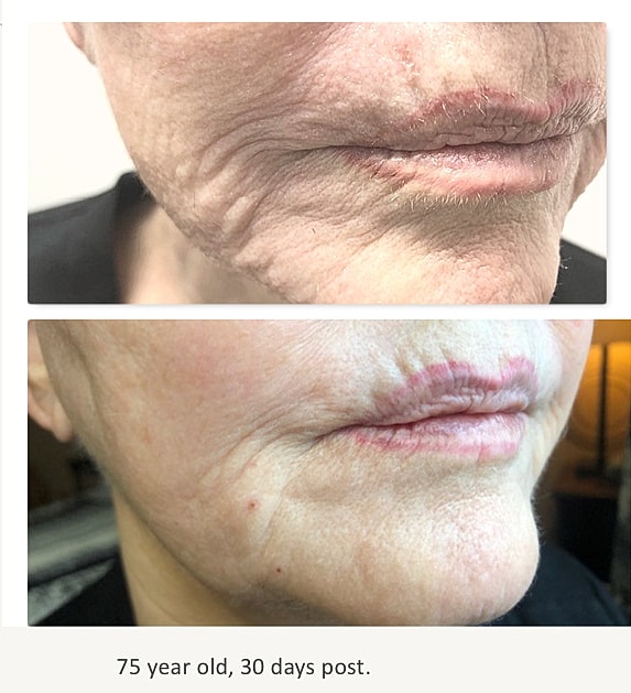 Plexr Before & After