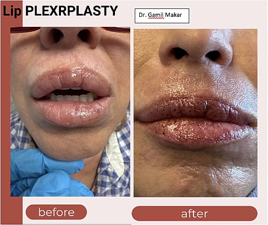 Plexr Before & After