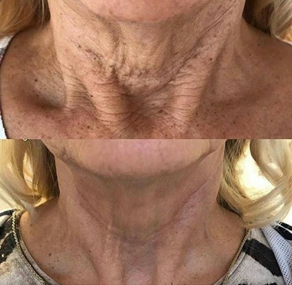 Plexr Before & After