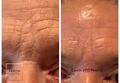 Plexr Before & After