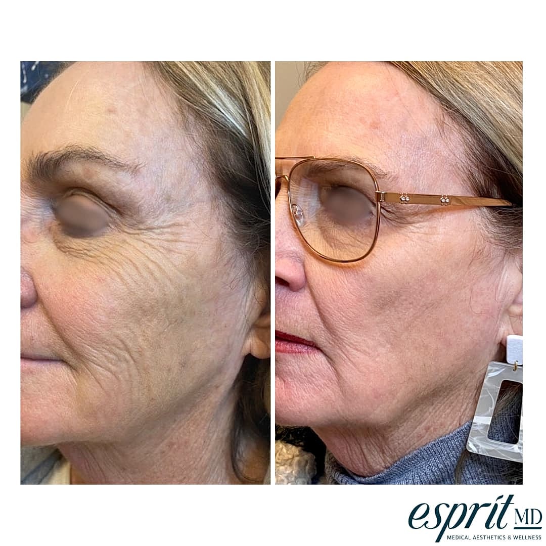 Plexr Before & After