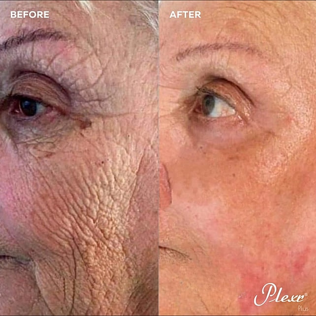 Plexr Before & After