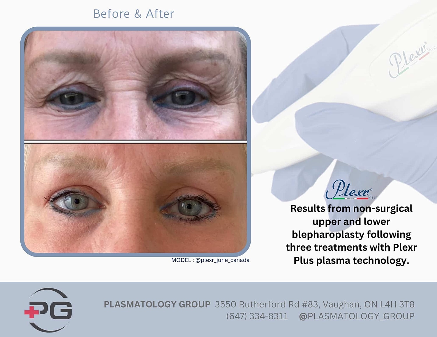 Plexr Before & After