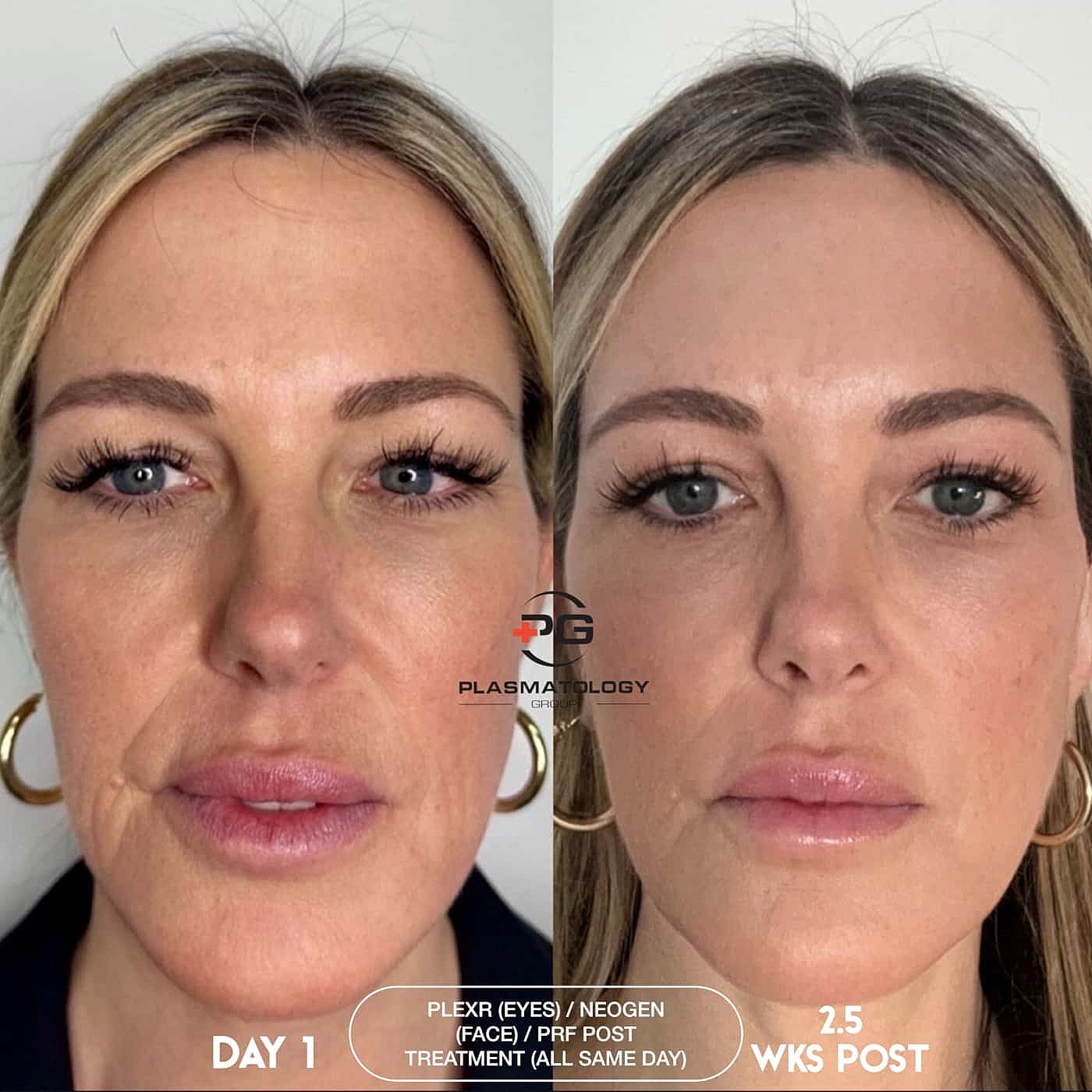 Plexr Before & After