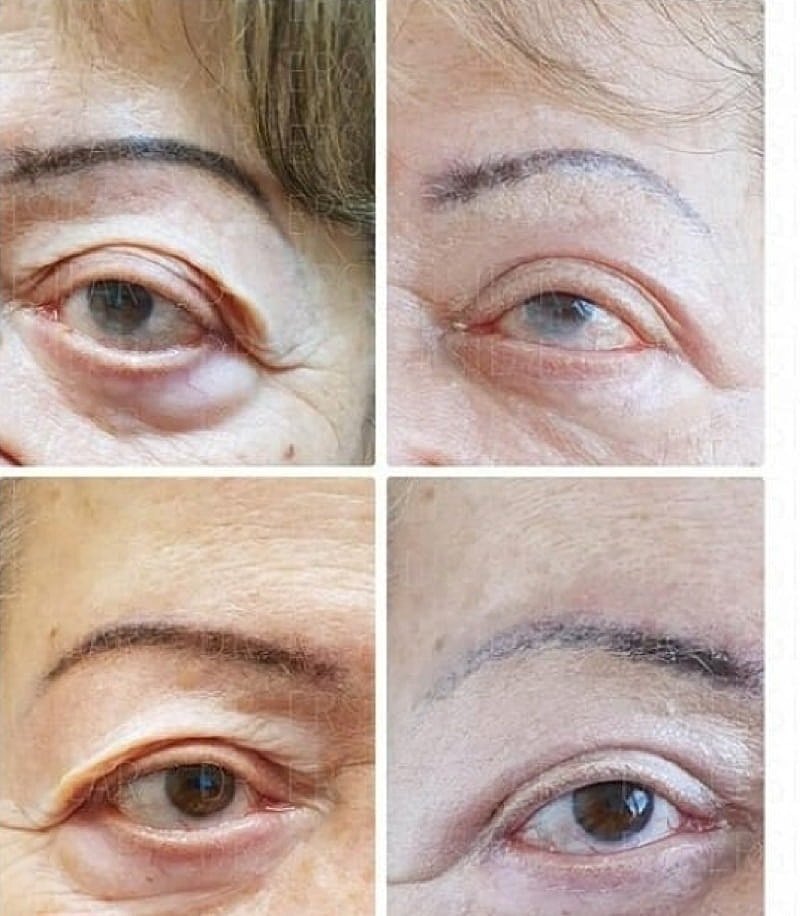 Plexr Before & After