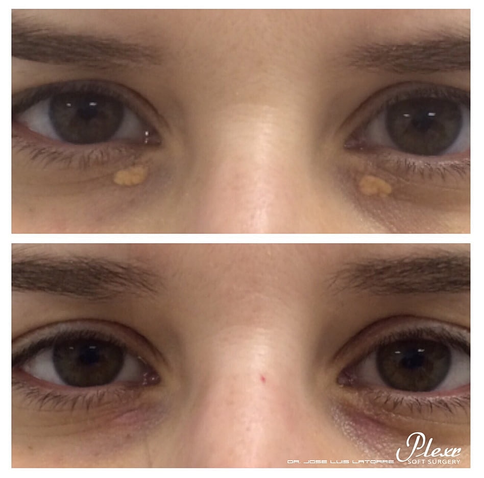 Plexr Before & After