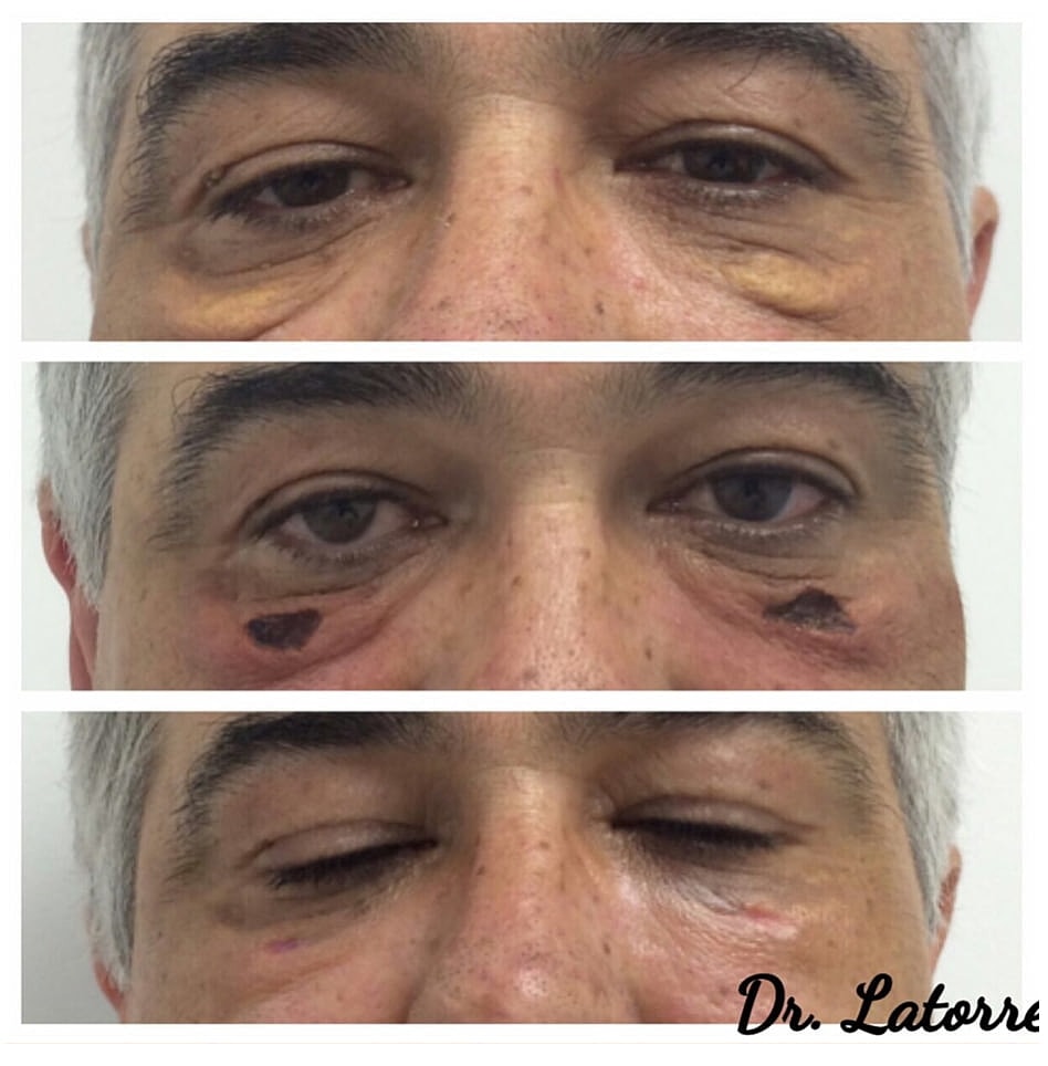 Plexr Before & After