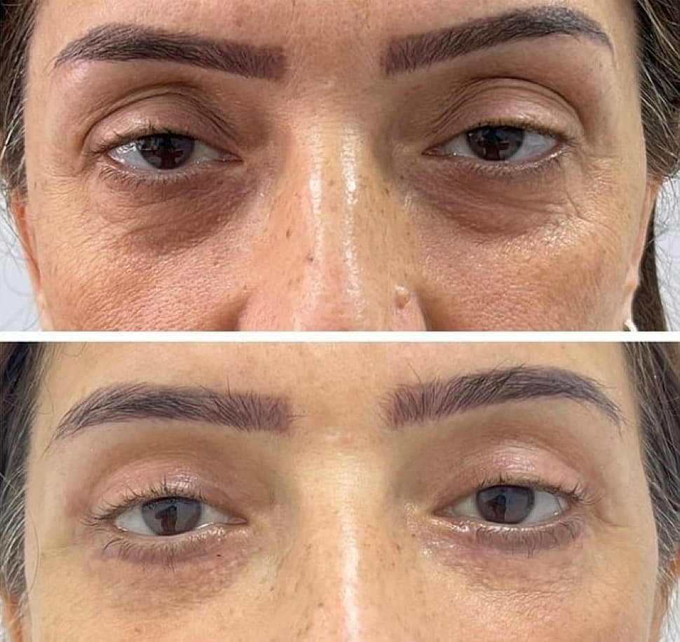 Plexr Before & After