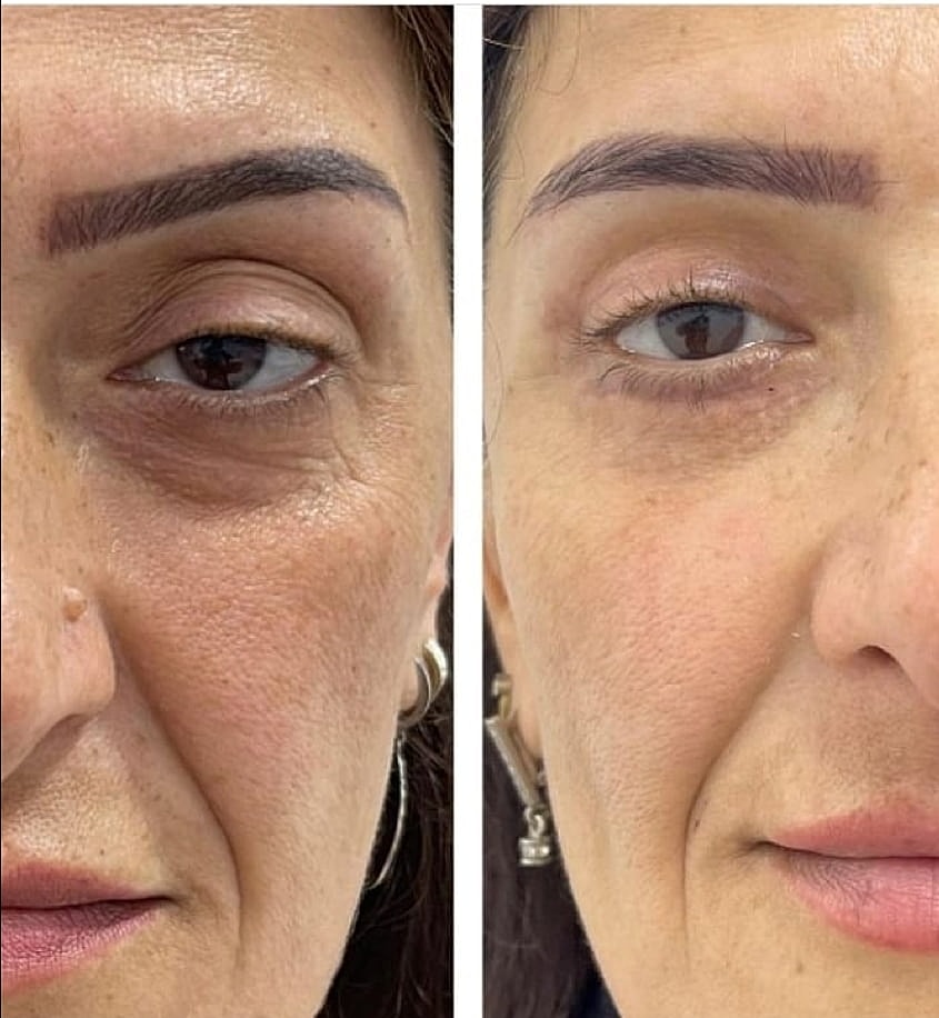 Plexr Before & After