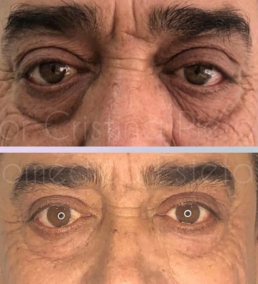 Plexr Before & After