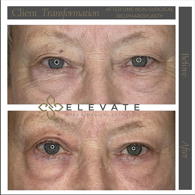 Plexr Before & After