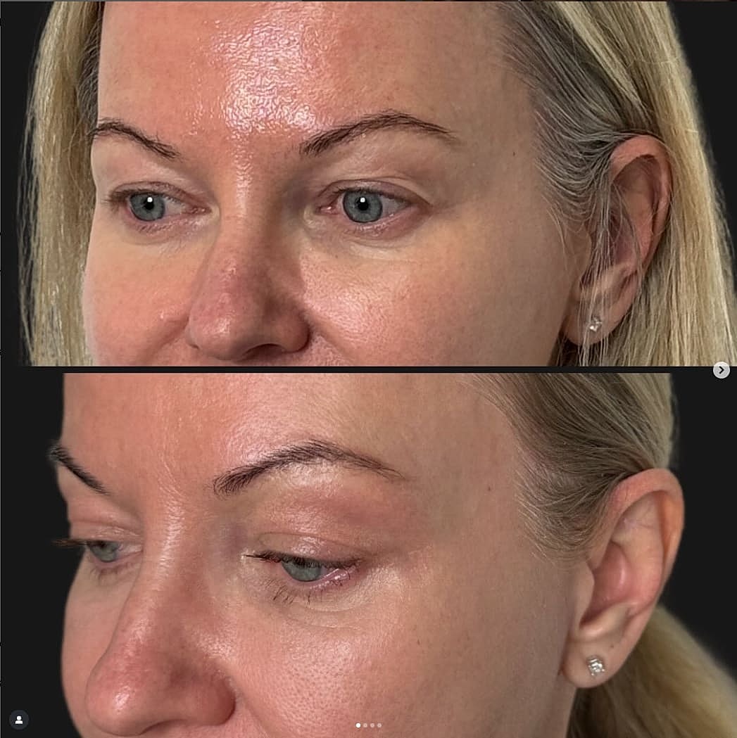 Plexr Before & After