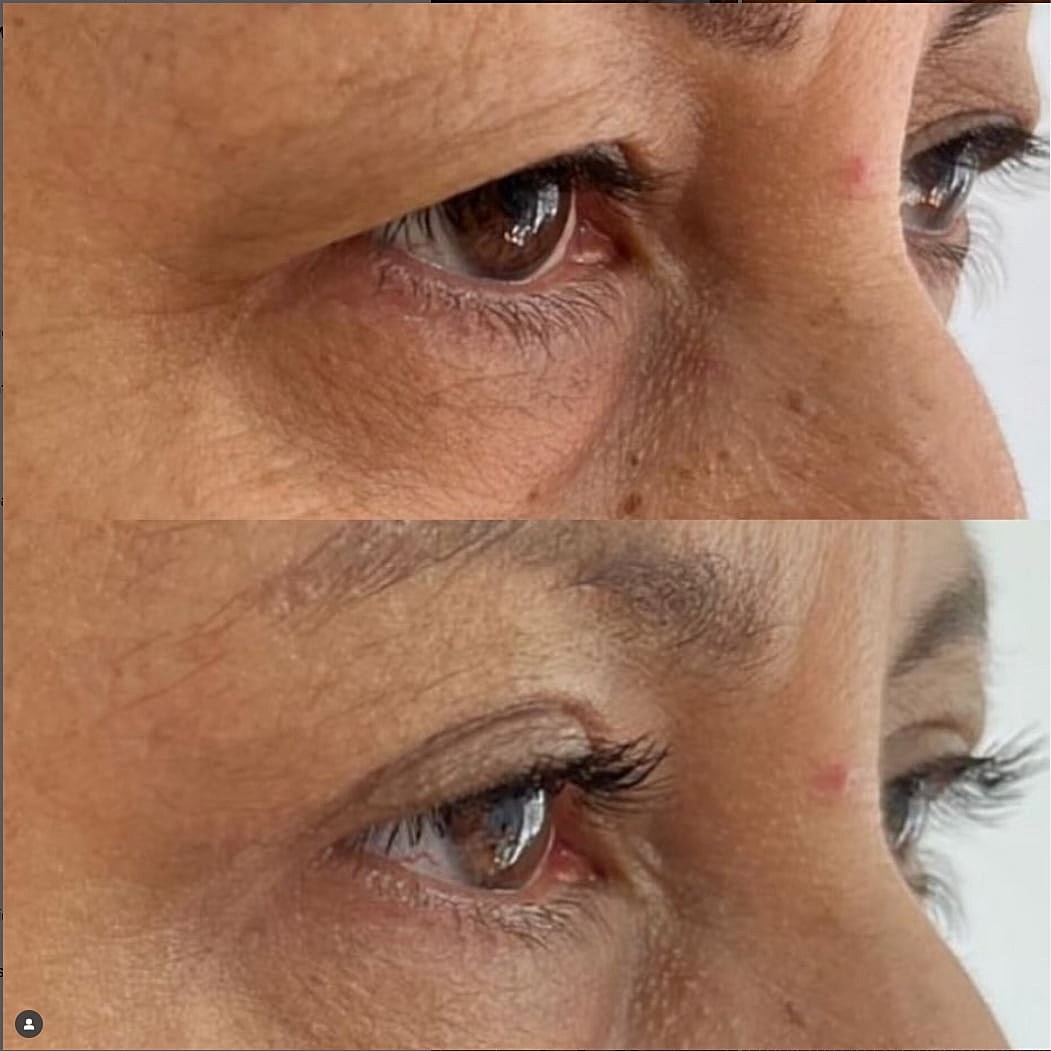 Plexr Before & After