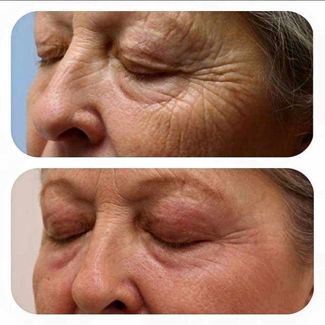 Plexr Before & After