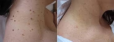 Plexr Before & After