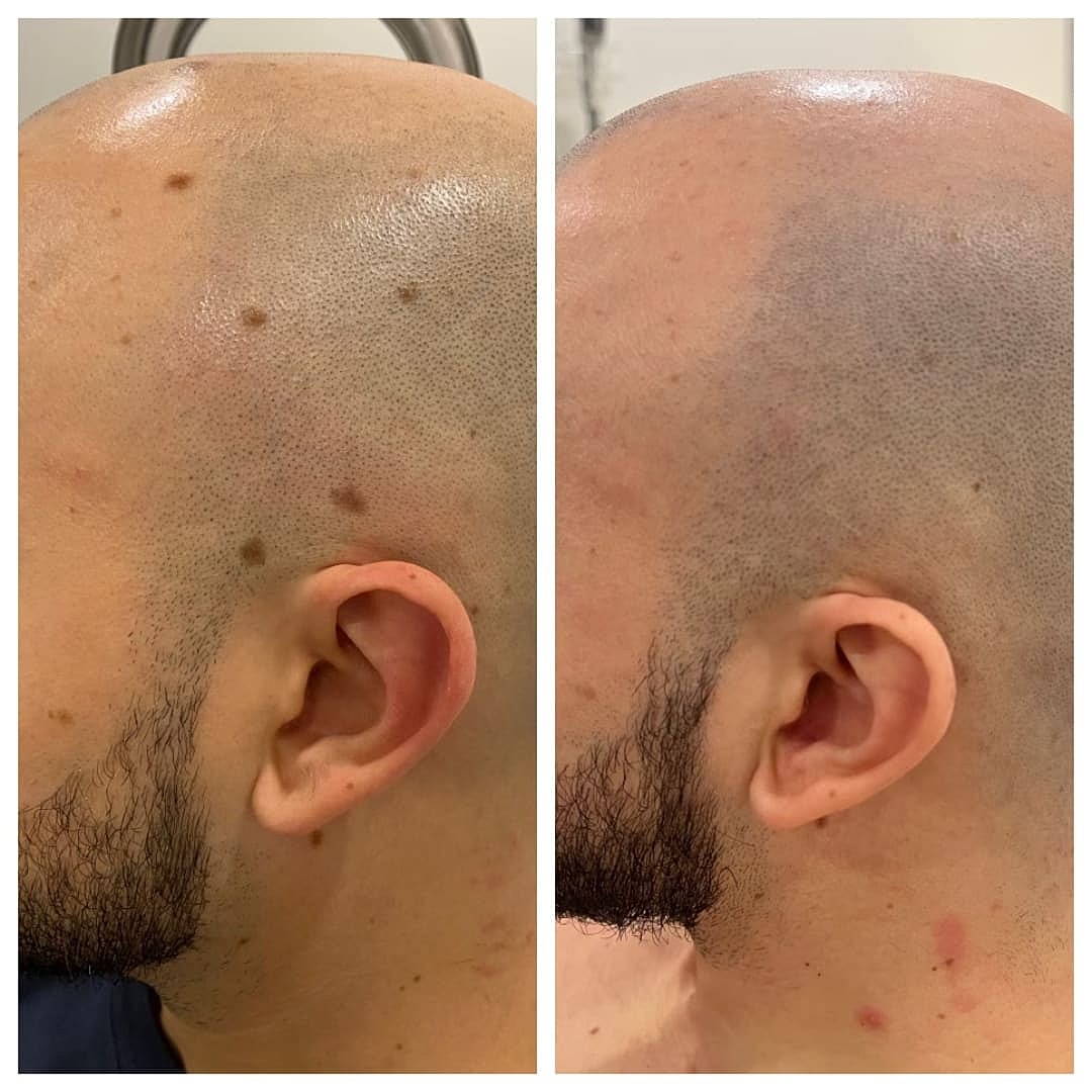 Plexr Before & After