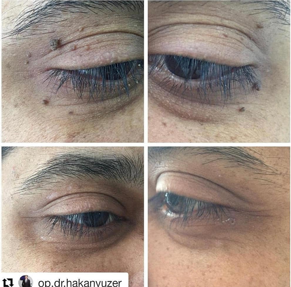 Plexr Before & After