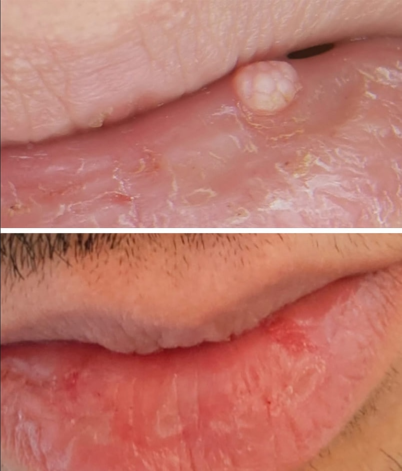 Plexr Before & After