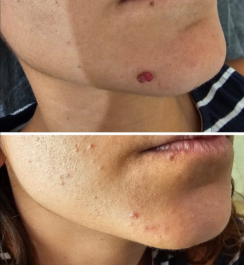 Plexr Before & After