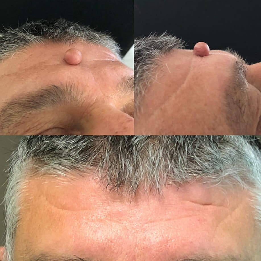 Plexr Before & After