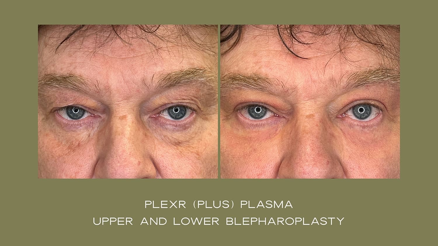 Plexr Before & After