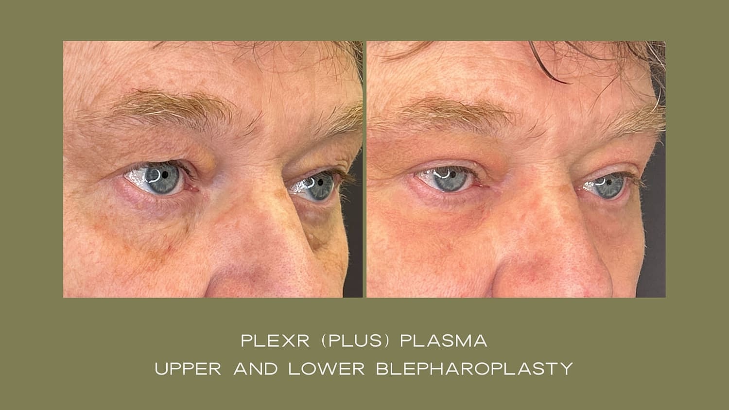 Plexr Before & After